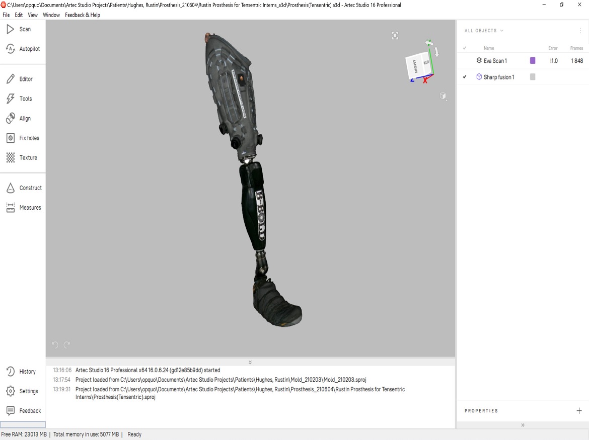 How Artec 3D & HP helped create a revolutionary 3D-printed prosthesis